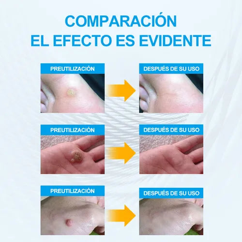 Wart Remover™ Elimina Verrugas sin Irritar tu Piel