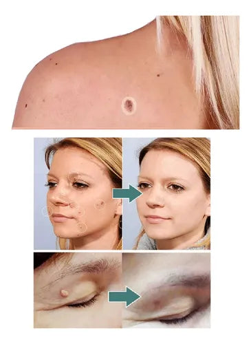 FormuClear Parches Anti Verrugas ¡216 parches!