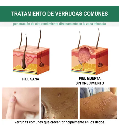 Wart Remover™ Elimina Verrugas sin Irritar tu Piel