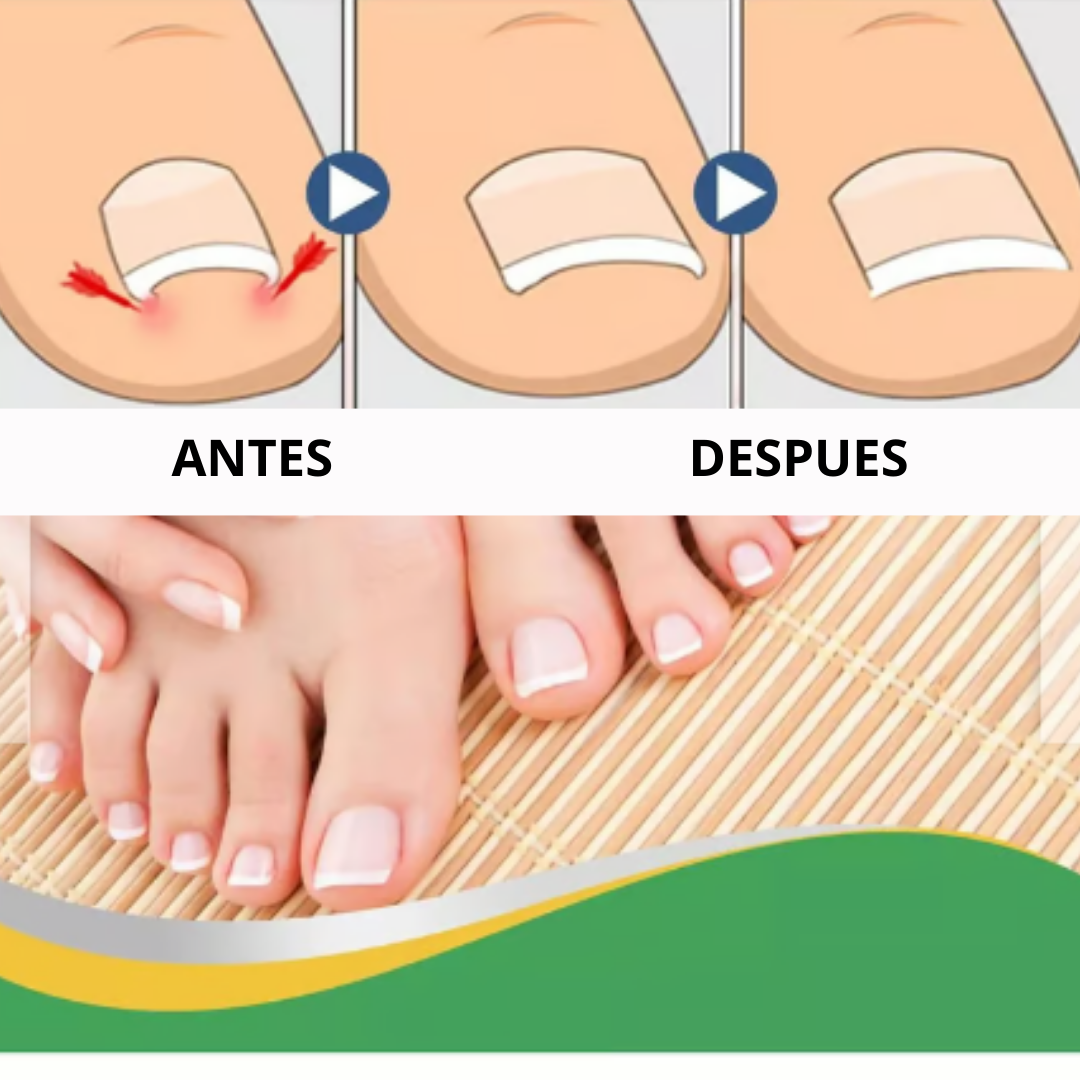 UñaLibre® Corrector Natural para Uñas Encarnadas y Hongos 2x1