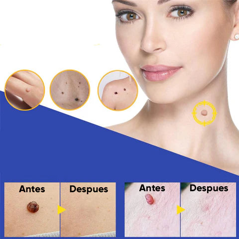 FormuClear Parches Anti Verrugas ¡216 parches!