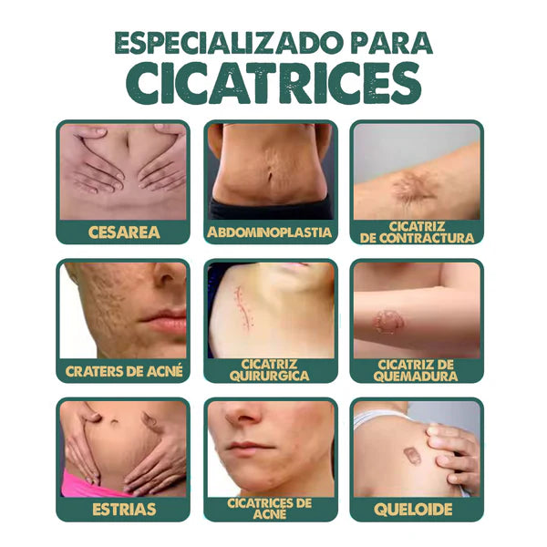 South Moon™ Spray Avanzado para las Cicatrices y Queloides