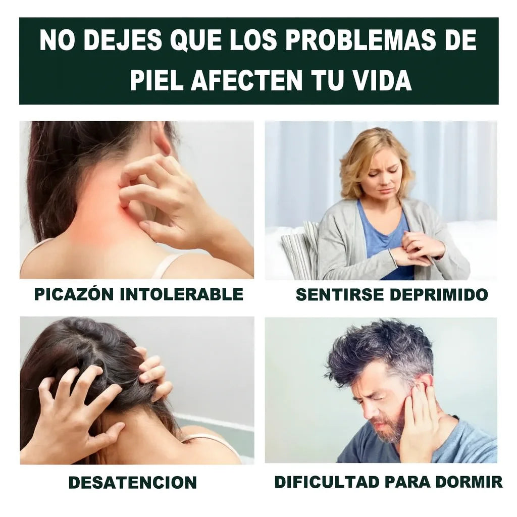 CalmiSkin™ Crema Para Aliviar Picazón de Psoriasis