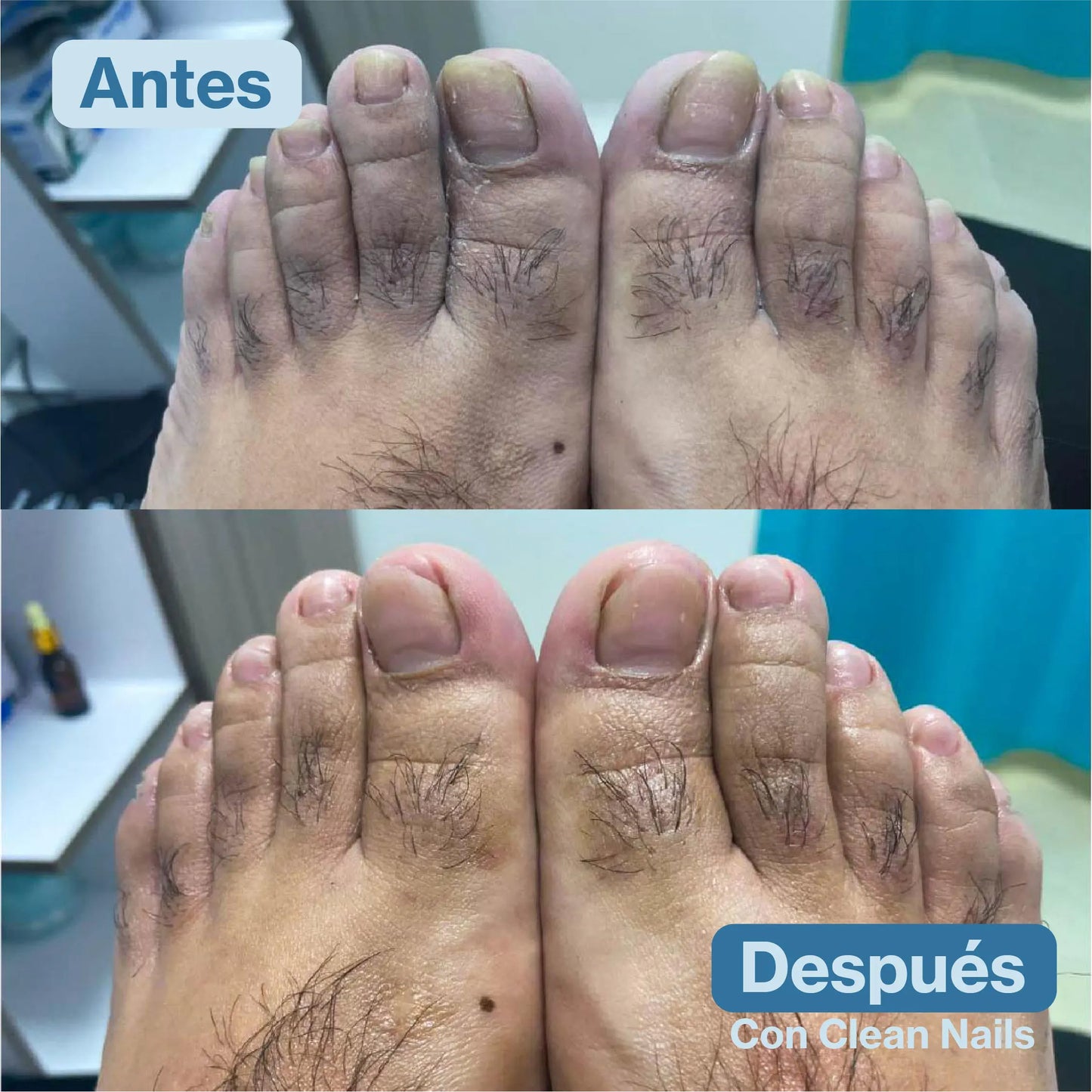 Clean Nails™ Elimina Hongos y Fortalece tus Uñas 2x1