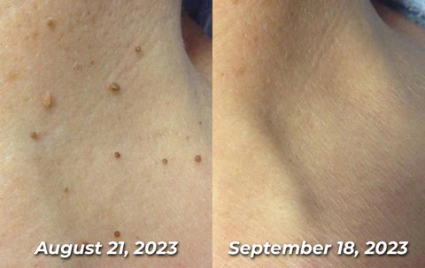 Wart Remover™ Elimina Verrugas sin Irritar tu Piel