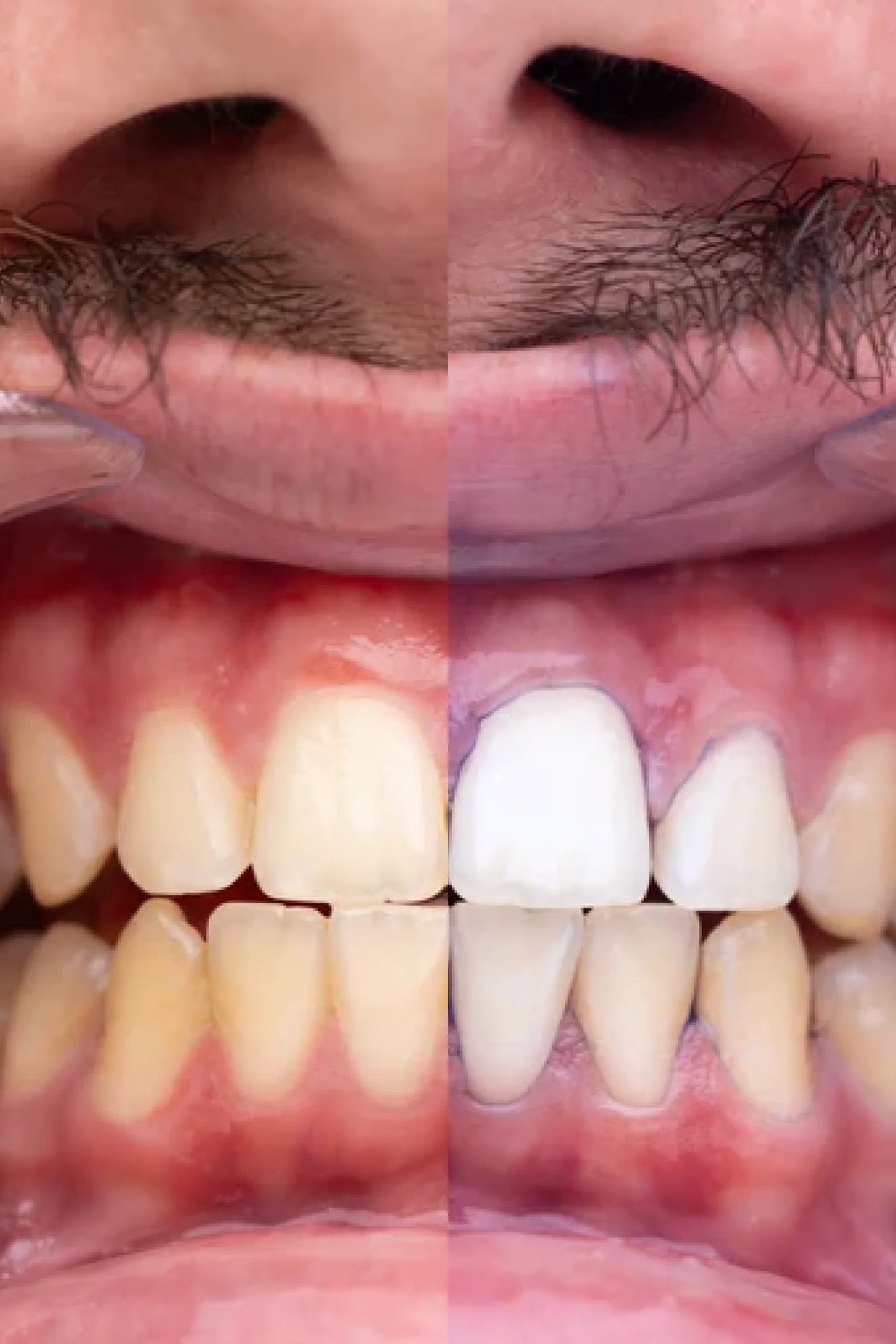 Hismile V34™ Luce una sonrisa más blanca al instante 2x1