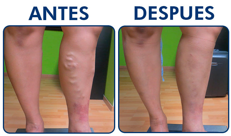 CircuVive™ Parche Revitalizante Piernas Circulación Varices 3x1